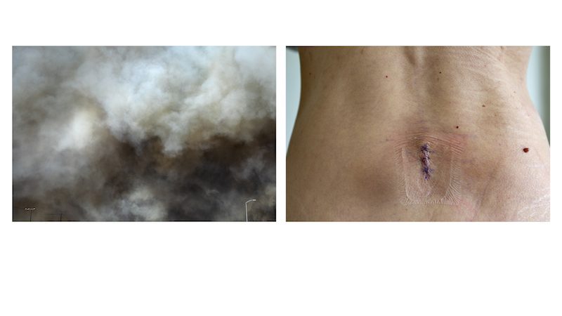 A pair of photographs: smoke or a cloud, and the small of a person back, with a small incision stitched close along the spine.